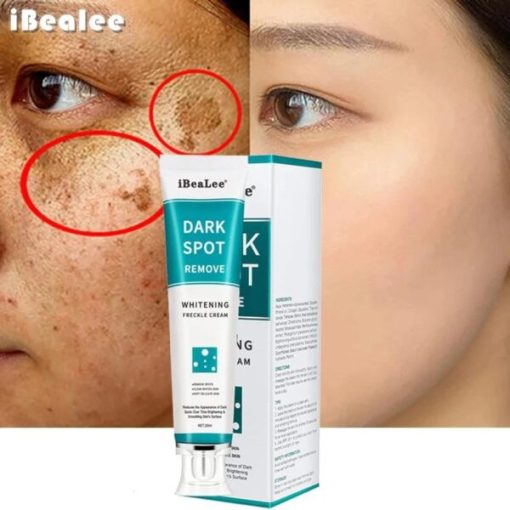 Best Whitening Freckle Cream -Remove Dark Spots